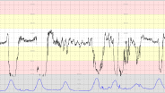 CTG Case 13