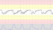 CTG Case 15