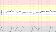 CTG Case 16