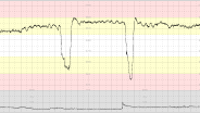 CTG Case 17