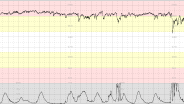 CTG Case 18