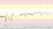 CTG Case 19